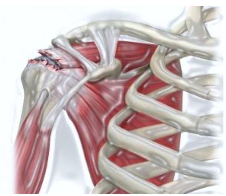 LESIONI DELLA CUFFIA DEI ROTATORI