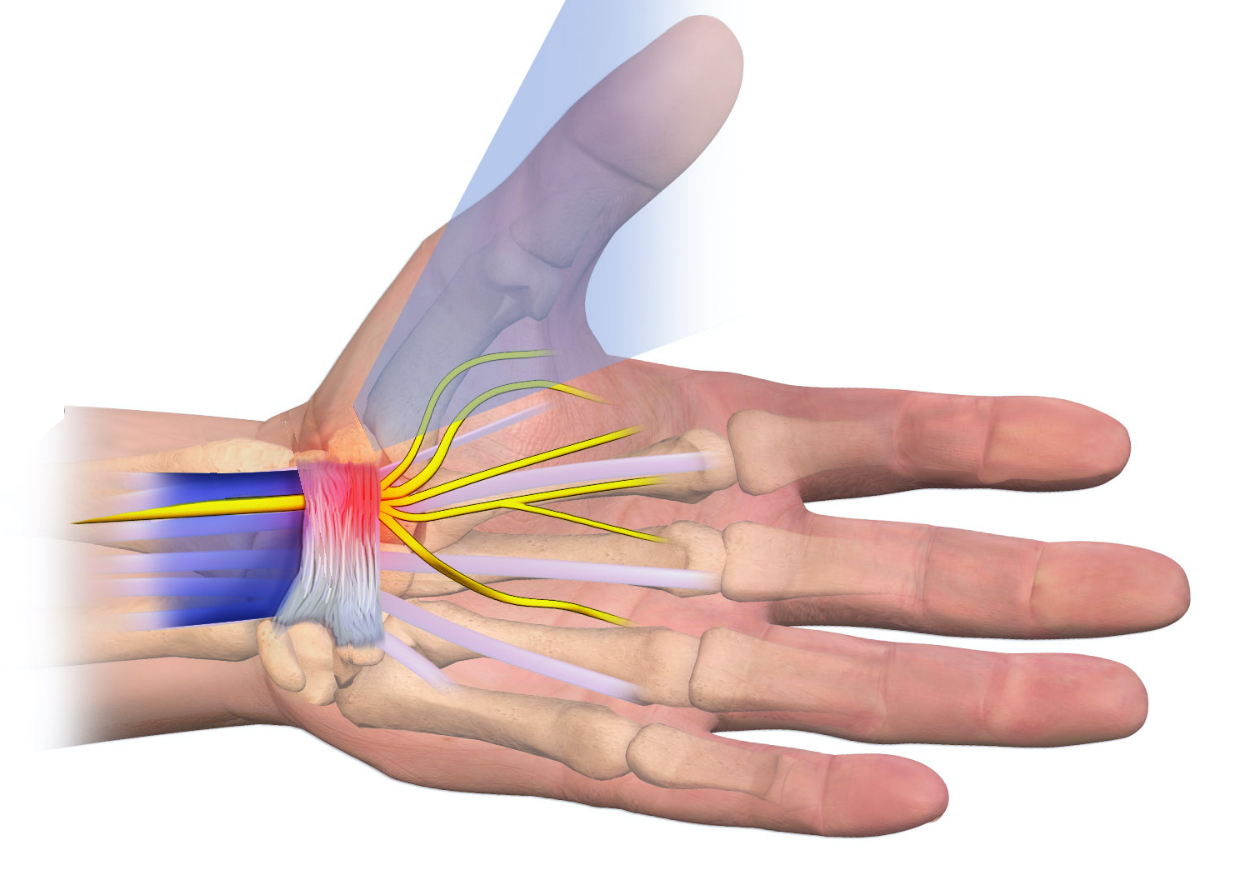 Sindrome Tunnel Carpale